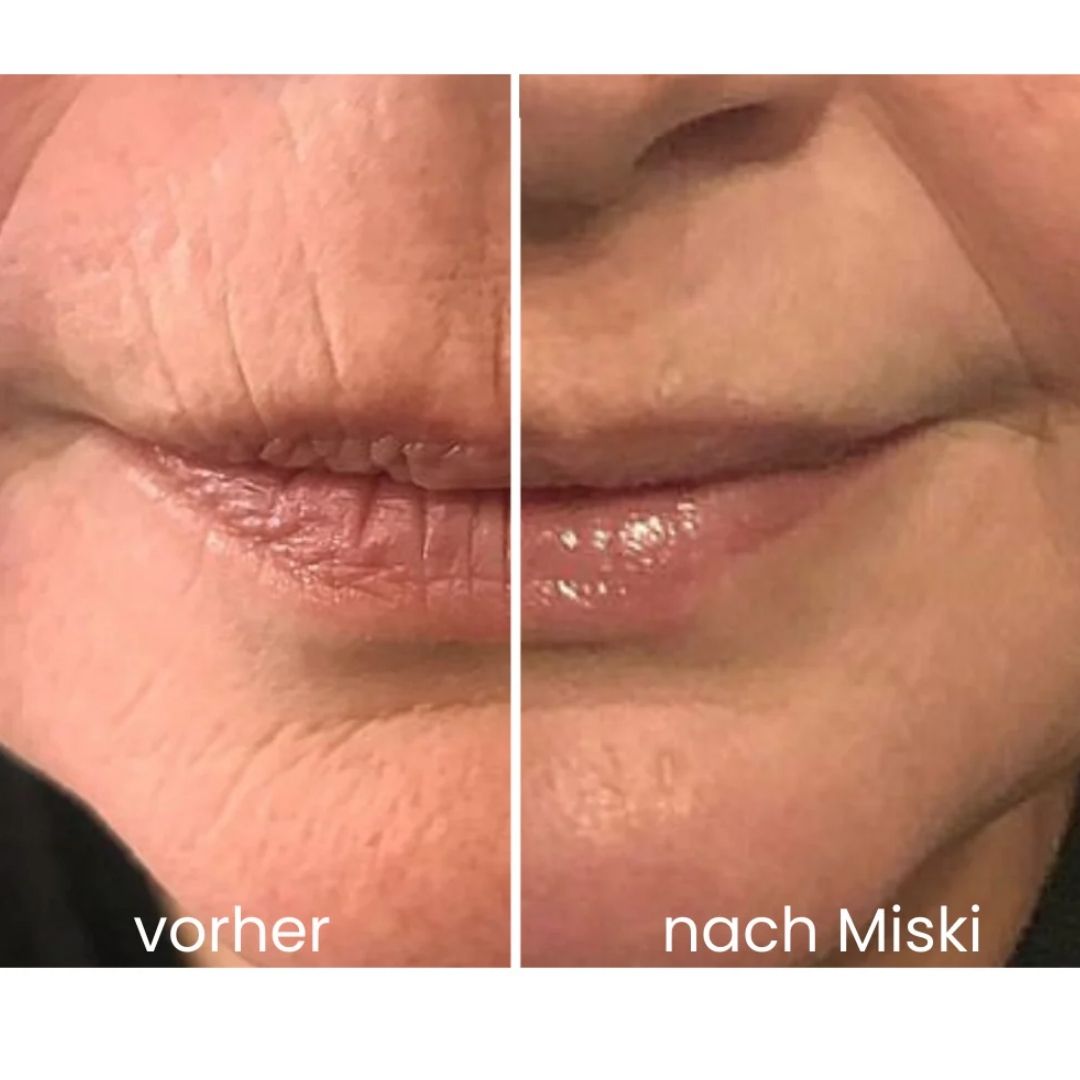 Miski Micro-Infusion-System