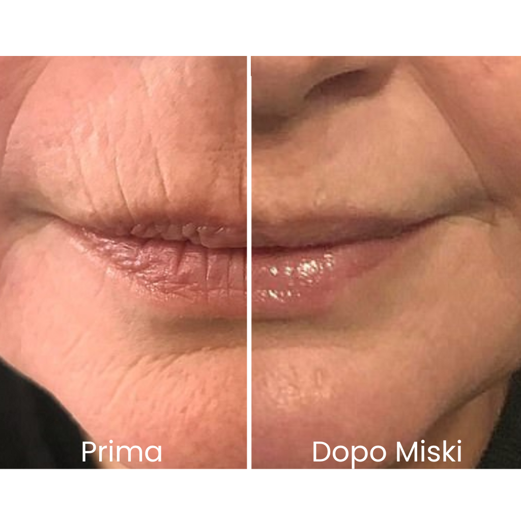 Miski Micro Infusion System IT